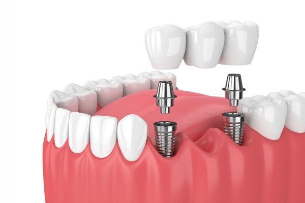 Hiểu như thế nào về phương pháp trồng răng implant? 