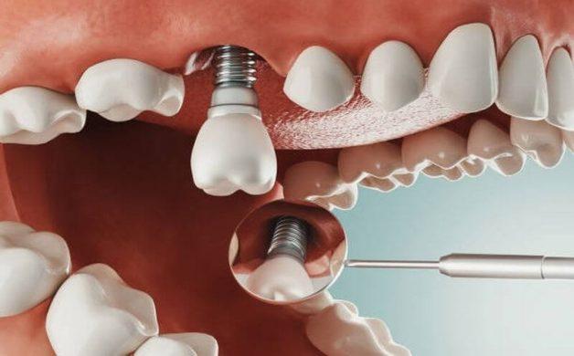 Nhược điểm khi sử dụng phương pháp trồng răng implant 