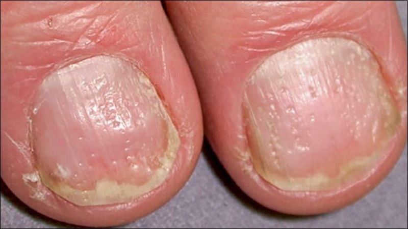 da quanh móng tay bị khô