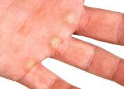 Làm thế nào để cải thiện tình trạng da tay bị chai sần?