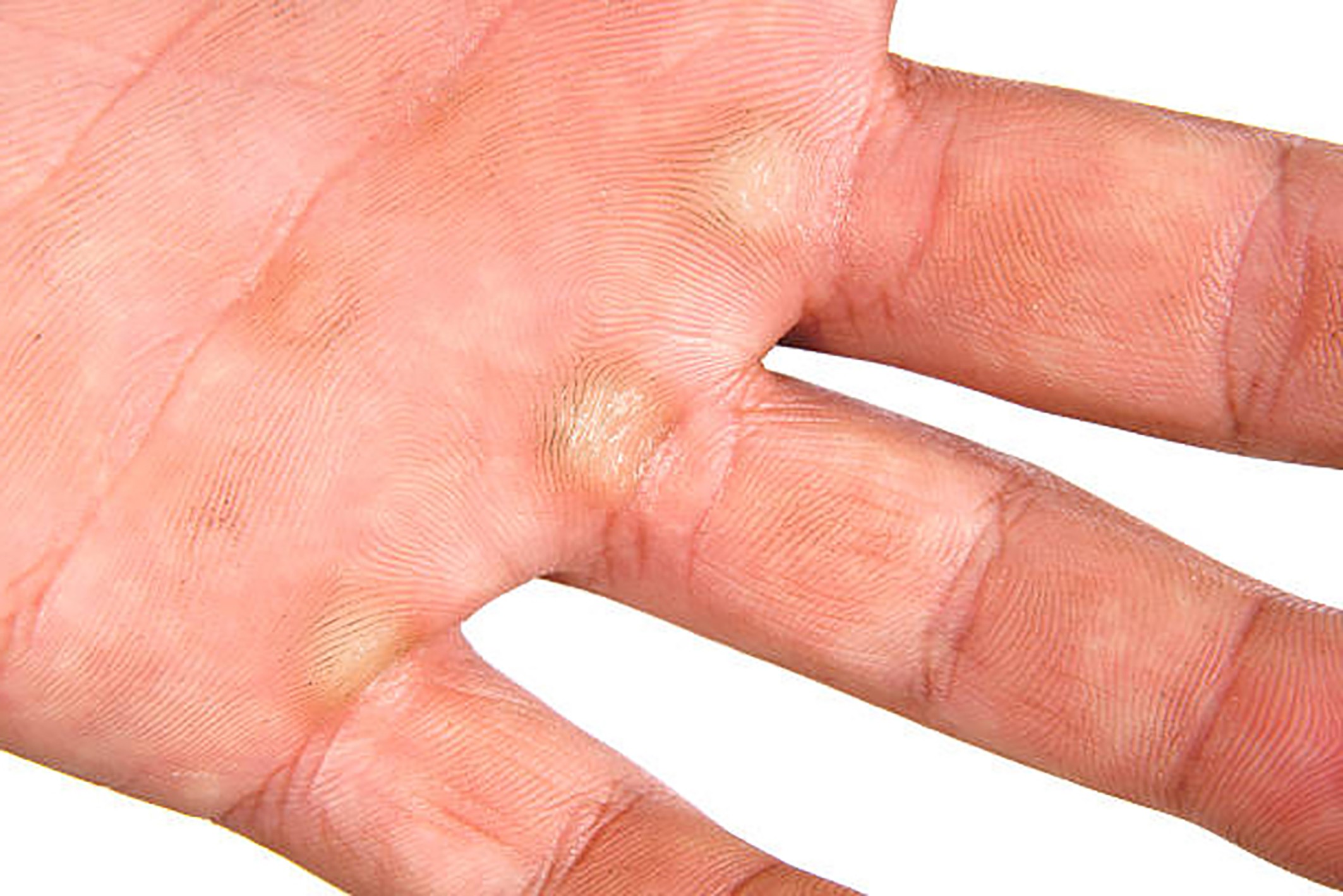 da tay bị chai sần