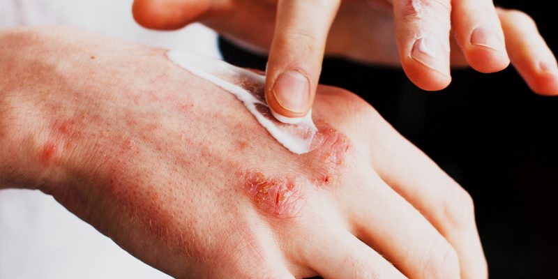 da tay bị dị ứng nổi sần ngứa