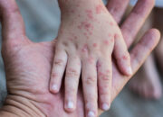 Da tay bị dị ứng nổi sần ngứa do đâu?