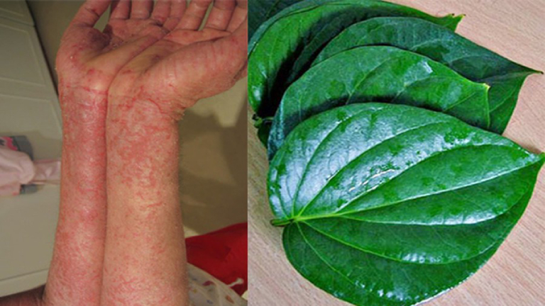 da tay bị dị ứng