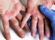 Da tay bị đỏ rát có nguy hiểm không?