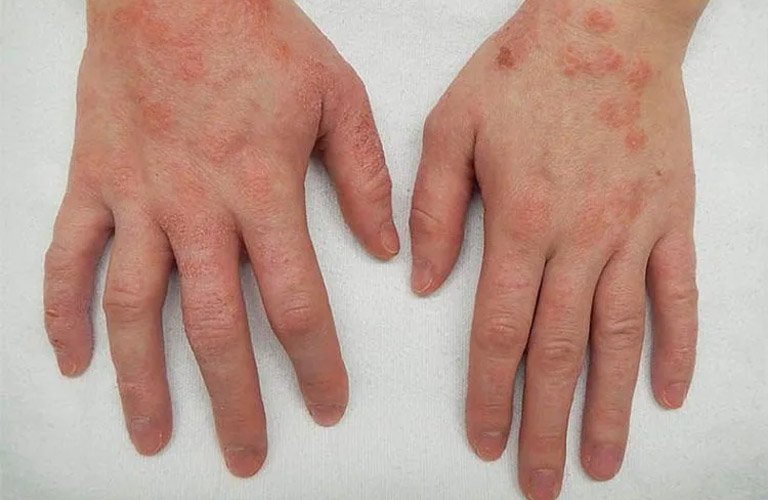 da tay bị sần sùi không mịn