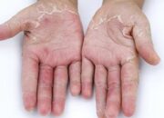 Da tay bị lột thiếu chất gì? Làm thế nào để cải thiện tình trạng này?