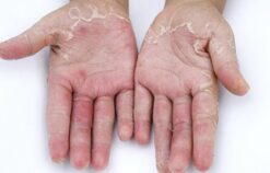 Da tay bị lột thiếu chất gì? Làm thế nào để cải thiện tình trạng này?