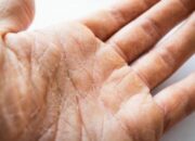 Da tay bị mốc trắng phải xử lý như thế nào?