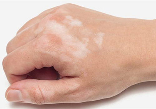 da tay có đốm trắng nhỏ