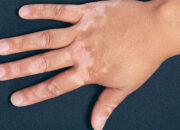 Tìm hiểu nguyên nhân da tay bị nổi đốm trắng