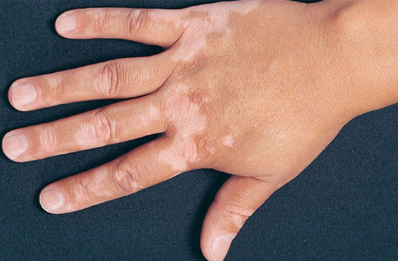 da tay bị đốm trắng