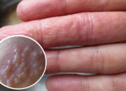 Da tay nổi mụn nước là biểu hiện của bệnh gì?