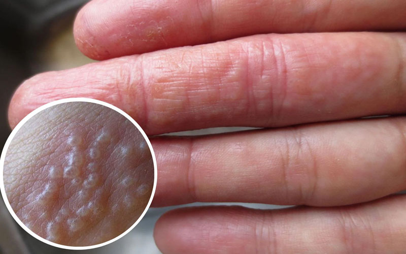 da tay nổi mụn nước