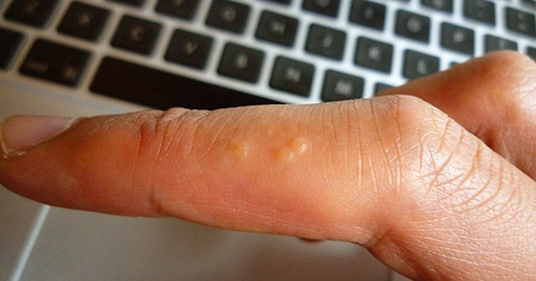 da tay nổi mụn nước