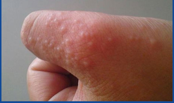 da tay nổi mụn nước