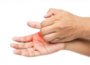 Da tay bị nóng rát là biểu hiện của bệnh gì?