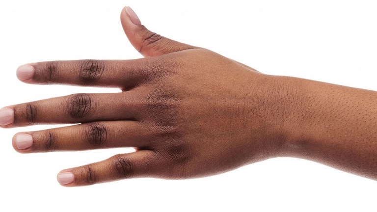 da tay bị sạm đen