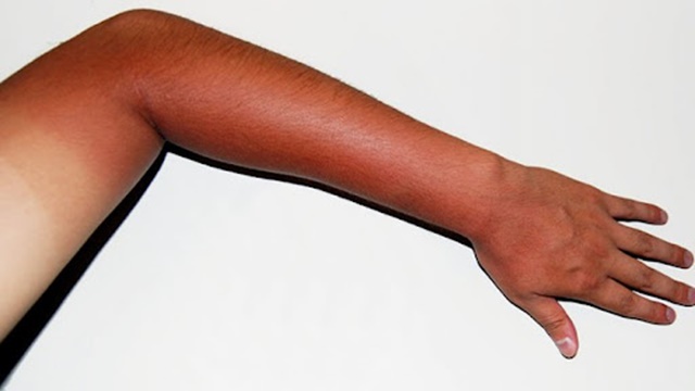 da tay bị thâm đen