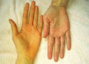 Da tay da chân bị vàng là triệu chứng của bệnh gì?