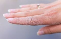 Da tay khô là thiếu chất gì? Làm thế nào để khắc phục tình trạng này?