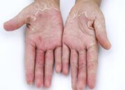 Da tay khô tróc vảy trắng là dấu hiệu của bệnh gì?