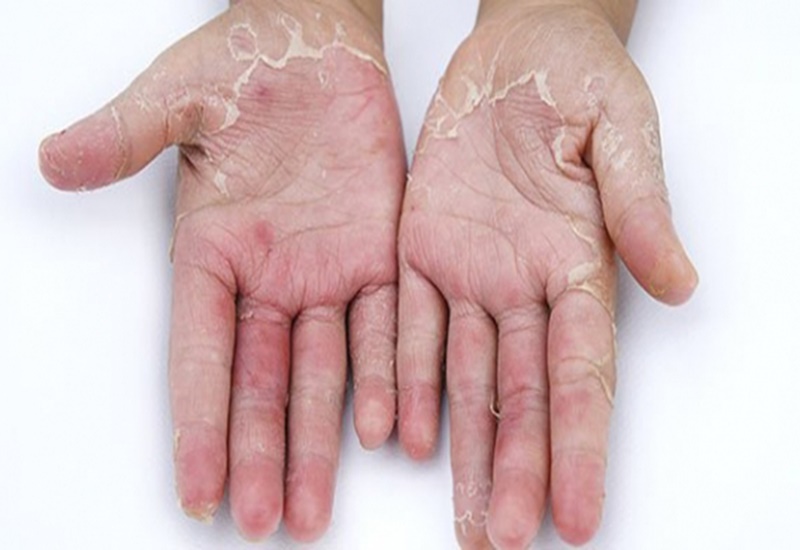 da tay bị tróc vảy trắng