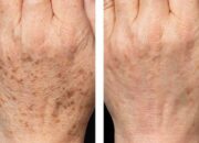 Da tay xuất hiện đốm nâu có nguy hiểm không?