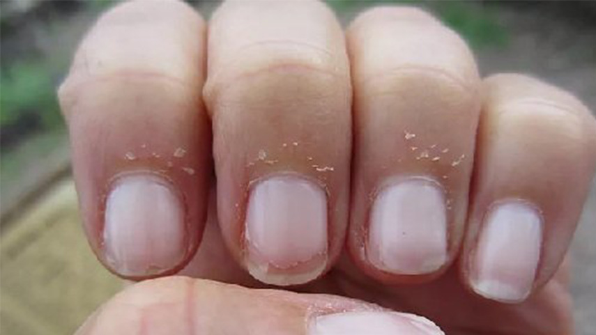 da xung quanh móng tay bị tróc