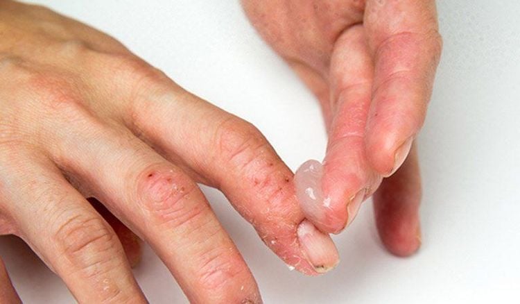 móng tay bị nước ăn 