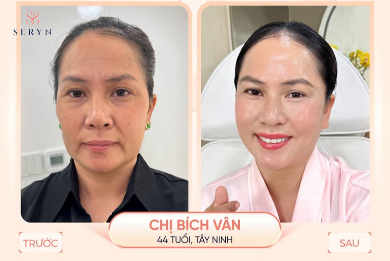 xóa nếp nhăn vùng trán